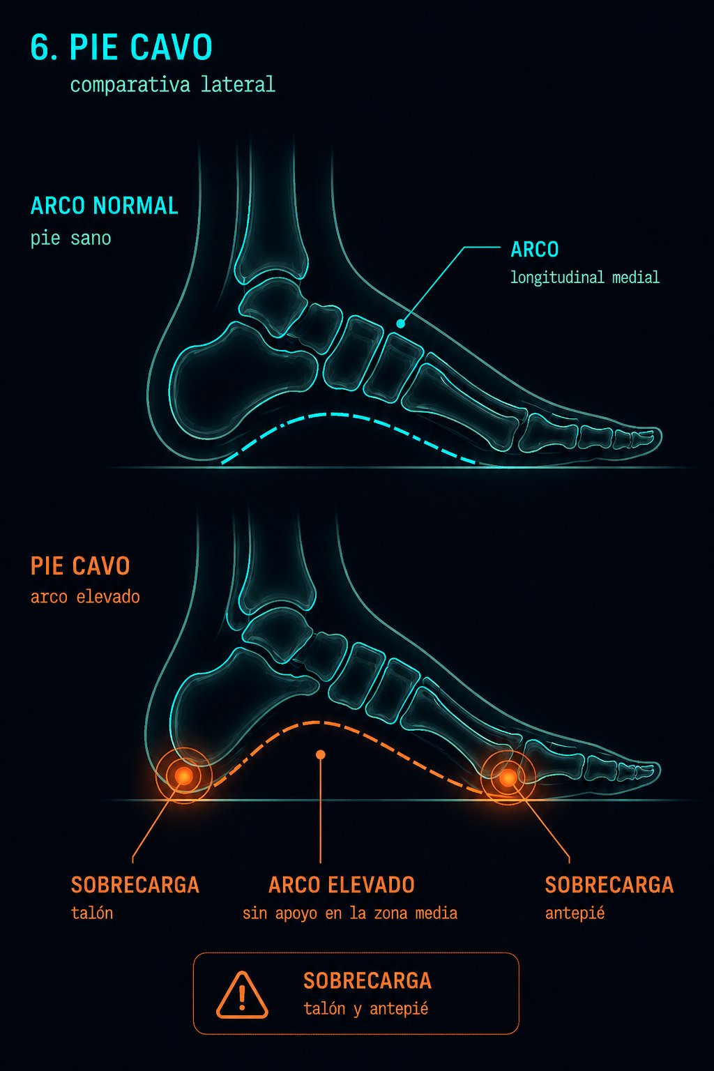 Comparativa lateral pie normal versus pie cavo con arco muy elevado y sobrecarga en talón y antepié